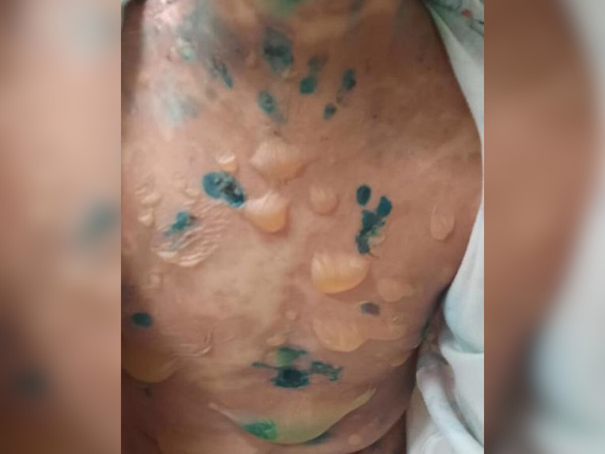 В ВКО у пациента выявили редкое заболевание