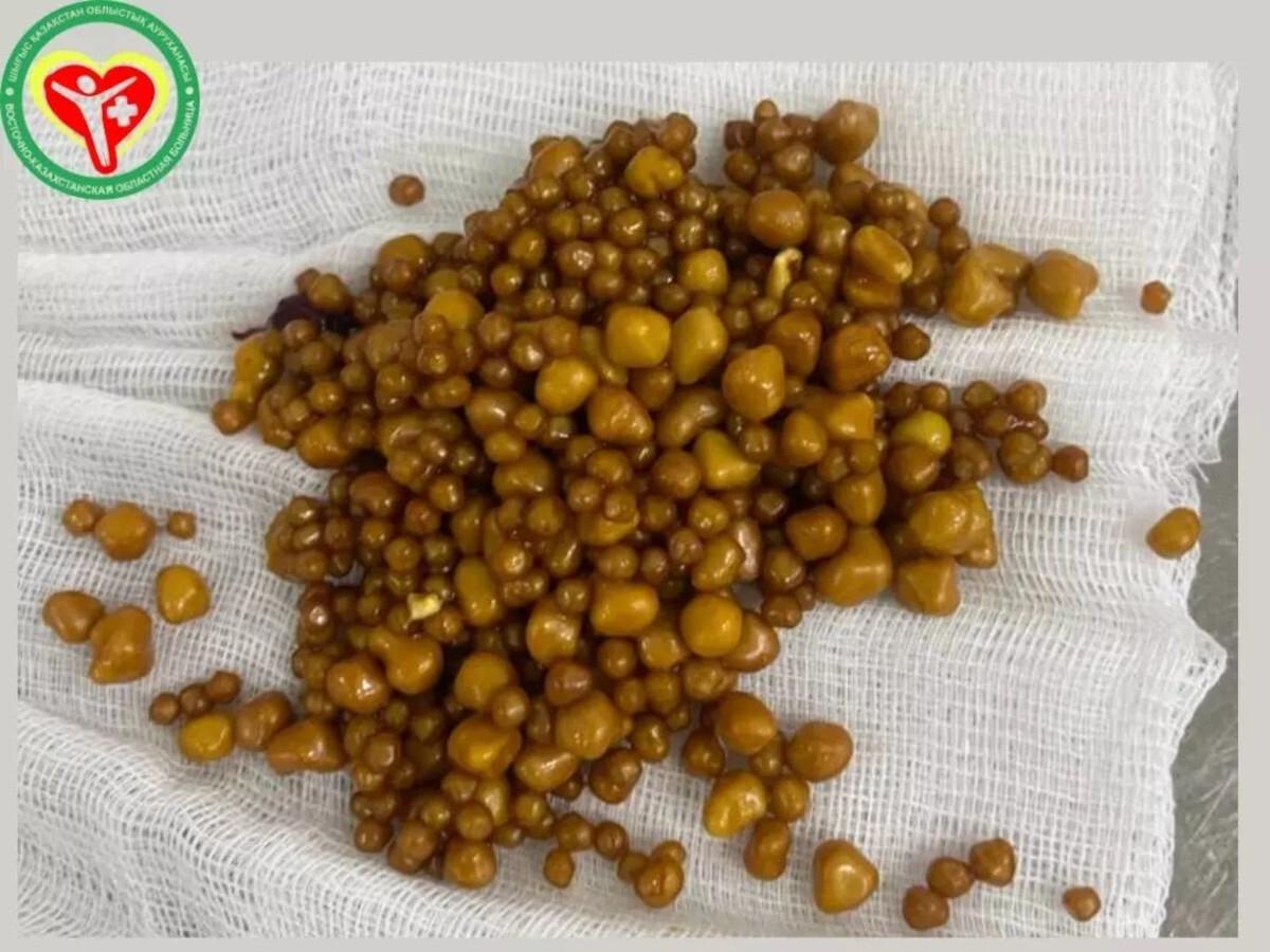 В ВКО хирурги извлекли из желчного пузыря пациентки целую горсть камней