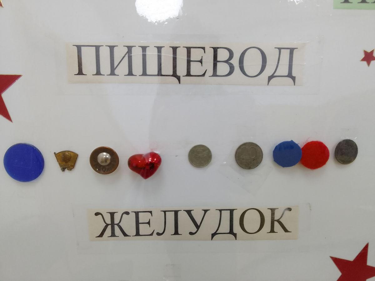 В Усть-Каменогорске «музей» проглоченных предметов постоянно пополняется новыми экспонатами 